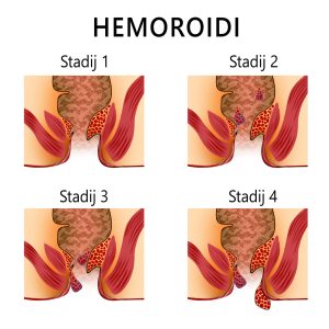 hemoroidi